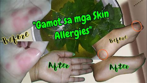 gamot para sa dry na balat|Skin Rashes Causes: Pangangati, Pamumula At .